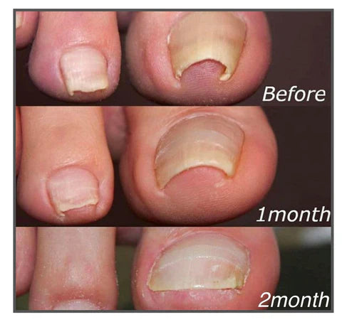 Fungal Nail Patches(21PCS)