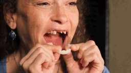 Adjustable Snap-On Dentures