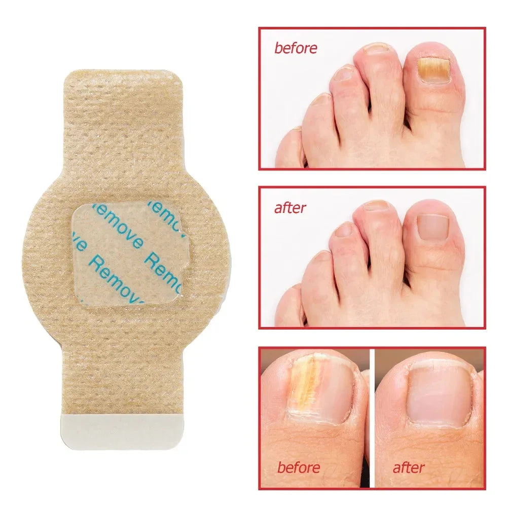 Fungal Nail Patches(21PCS)