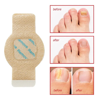 Fungal Nail Patches(21PCS)
