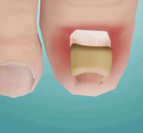 Fungal Nail Patches(21PCS)
