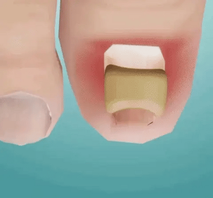 Fungal Nail Patches(21PCS)